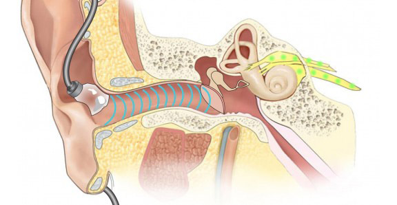 If the sound level exceeds what is optimal for the ear, hearing acuity begins to decline.